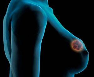 Breast Cancer